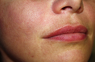 After Juvederm